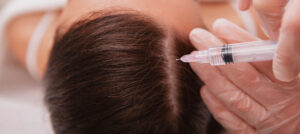 Leia mais sobre o artigo Mesoterapia capilar